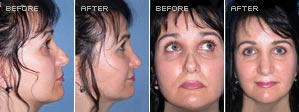 Revision Rhinoplasty