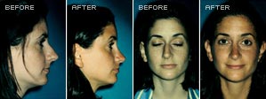 Rhinoplasty