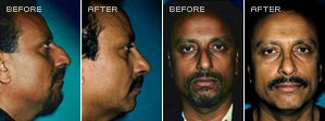 Rhinoplasty