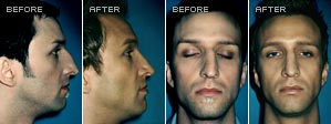 Rhinoplasty