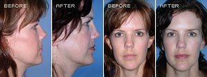 Rhinoplasty