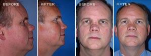 Rhinoplasty