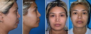 Rhinoplasty