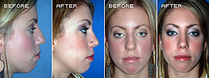 Rhinoplasty