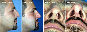 Rhinoplasty