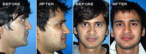 Rhinoplasty