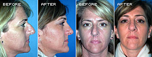 Rhinoplasty