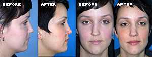 Rhinoplasty