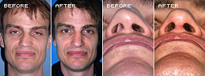 Rhinoplasty