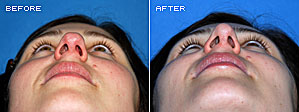 Rhinoplasty