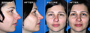 Rhinoplasty