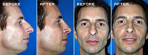 Rhinoplasty