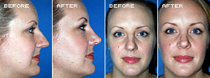 Rhinoplasty