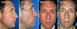 Rhinoplasty