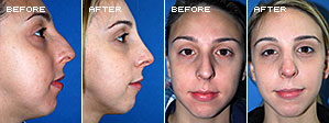 Rhinoplasty